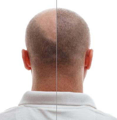 косопад плешиви присаждане на коса