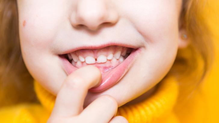 Детето ми има разстояние между зъбите - да се притеснявам ли?