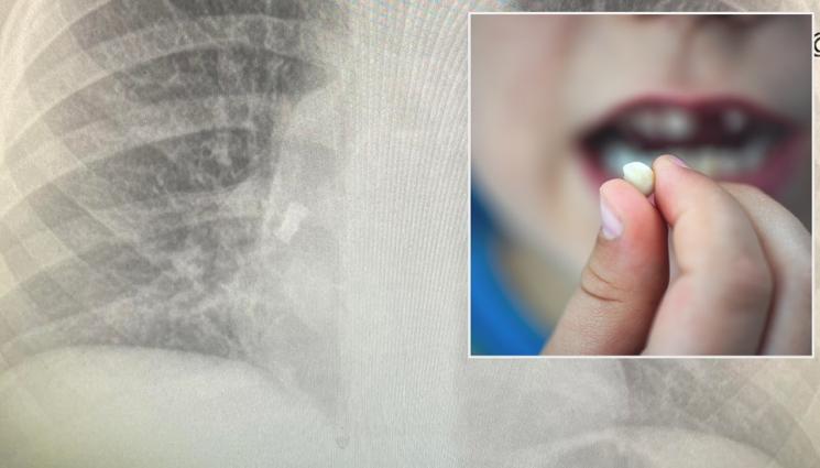 s - ИСТИНСКО ЧУДО! Спасиха дете със заседнал в трахеята зъб