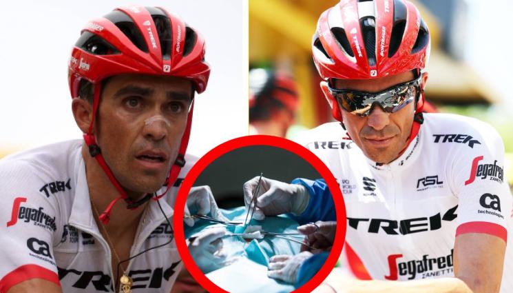 Алберто Контадор - ШОКИРАЩО: Махнали над 100 тумора от тялото на Контадор