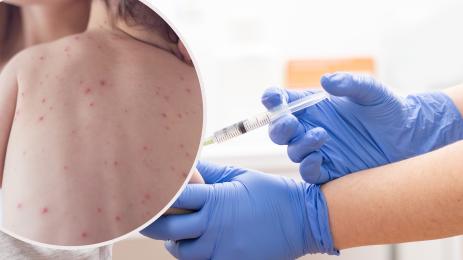 ваксини варицела