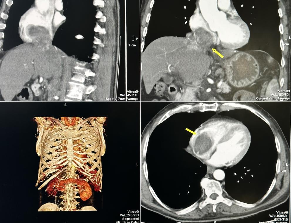  интервенция израстък 