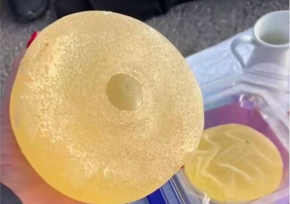 Силиконови импланти на битака – допустимо ли е от медицинска