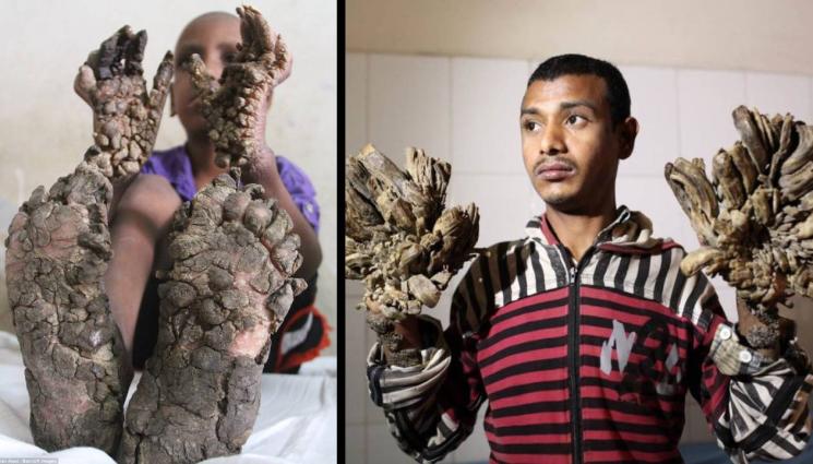 златно време - СИНДРОМЪТ НА ДЪРВОТО: Кожни израстъци превръщат хора в персонажи на Толкин!