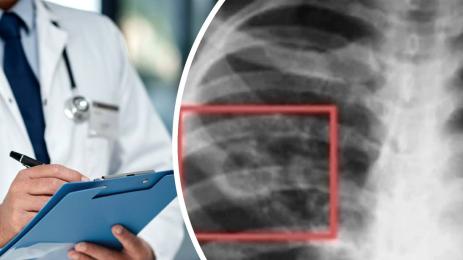 туберкулоза