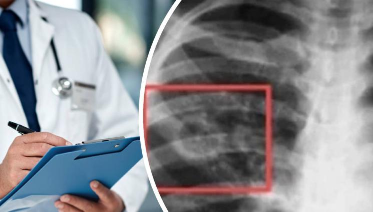 туберкулоза - ЗДРАВЕ с Телеграф: Безплатен скрининг за Жълтата гостенка