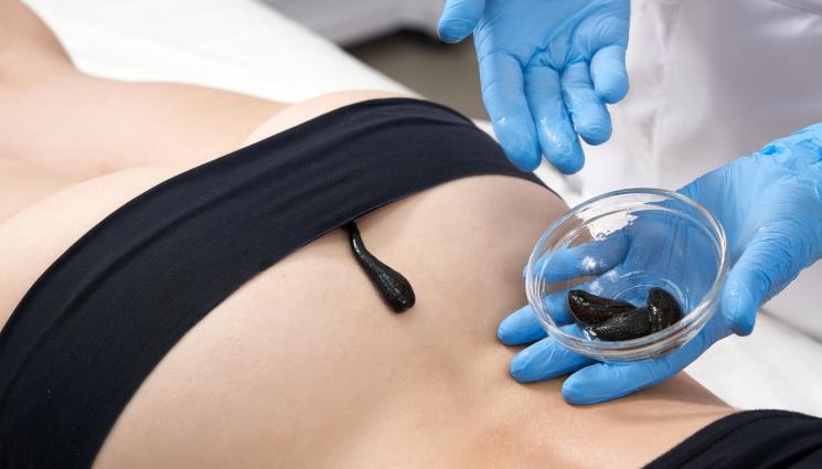 пиявици - ЗЛАТНО ВРЕМЕ: Пиявици изсмукват главоболието