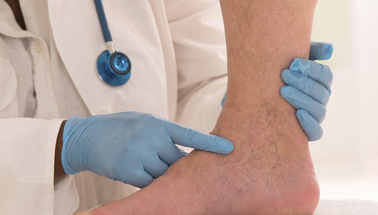 вени - ЗЛАТНО ВРЕМЕ: Синдром на Лериш може  да причини импотентност