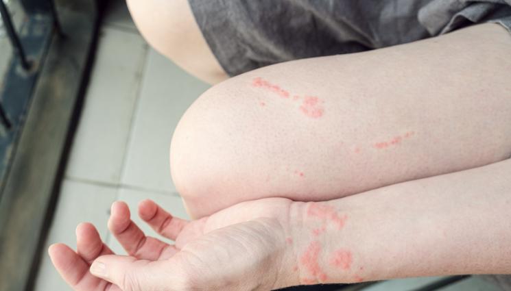 обрив - Парене и обрив след ужилване от медуза