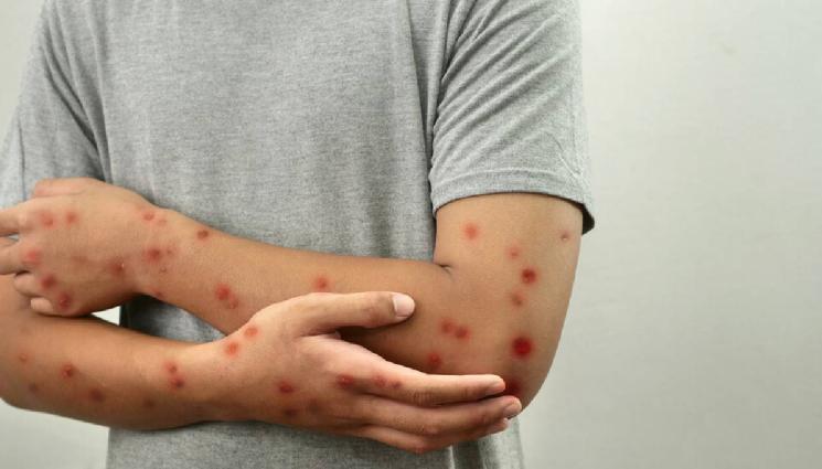 морбили - ТРЕВОЖНО: Броят на болните от морбили продължава да расте!