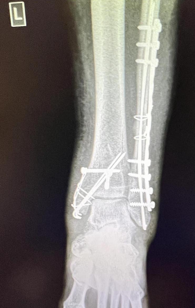 божана счупен крак