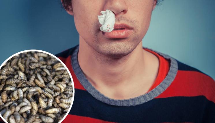 ларви - СТРАШНА ГНУС! Лекар извади десетки буби от носа на мъж (ВИДЕО)