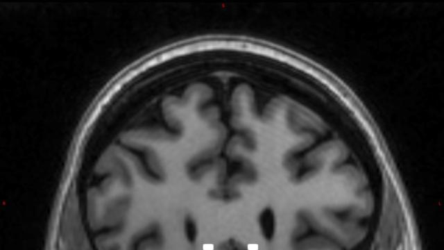 Мозъчен пейсмейкър може да се използва за тежка депресия (СНИМКИ)