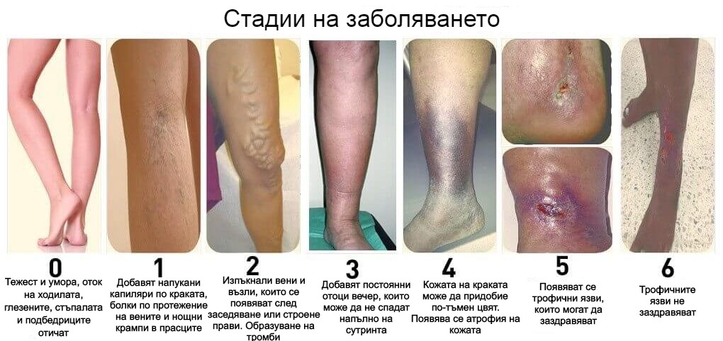 разширени вени