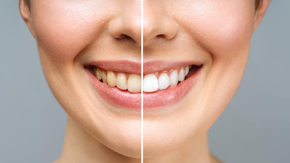 В борбата за по-бели зъби сме готови да отделим много