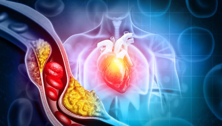 холестерол - ЗЛАТНО ВРЕМЕ: Холестеролът – ключ към лечението на рака