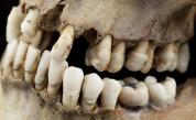 Кариеси, зъбна плака и инфекции: Слабото място на непобедимите викинги