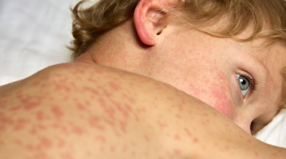 Случай на морбили и в София, РЗИ призовава за ваксинация