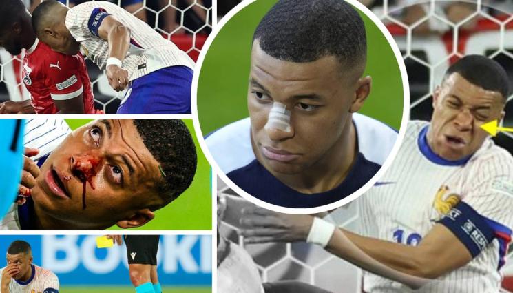 Килиан Мбапе нос - Мбапе се появи с превързан нос, май ще играе с маска срещу Нидерландия