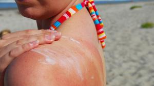Британски експерти дават съвети за справяне със слънчевите изгаряния 