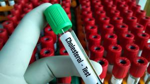 Високият холестерол е изключително опасно състояние което се характеризира с