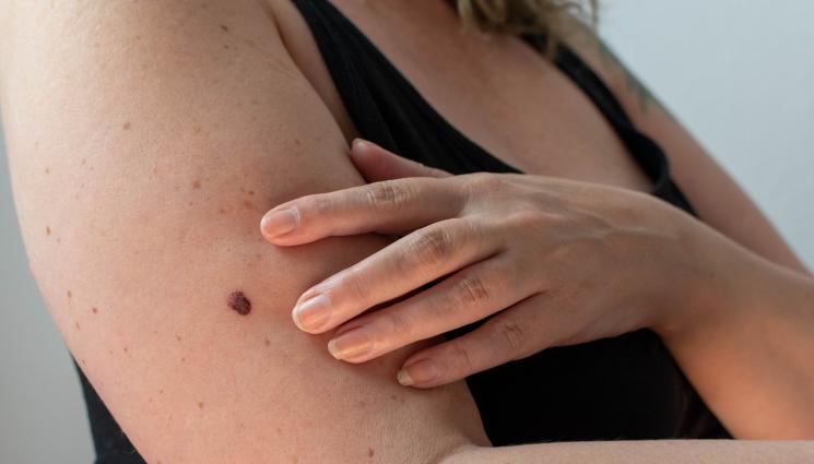 бенка - ЗЛАТНО ВРЕМЕ: Трябва ли да се паникьосаме, ако случайно откъснем бенка?