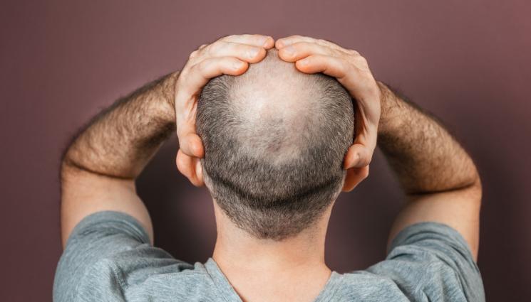 плешив - ТОВА ЛИ Е ПАНАЦЕЯТА? Учени разкриха причината за оплешивяването