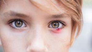 Ечемикът на окото е често срещан проблем който може да