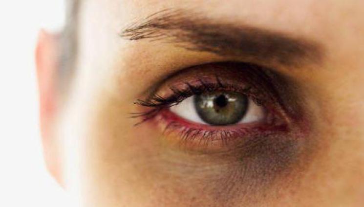 насинено око - КАКВО СЕ СЛУЧВА? Фолкаджийка се появи с насинена физиономия! (СНИМКА)