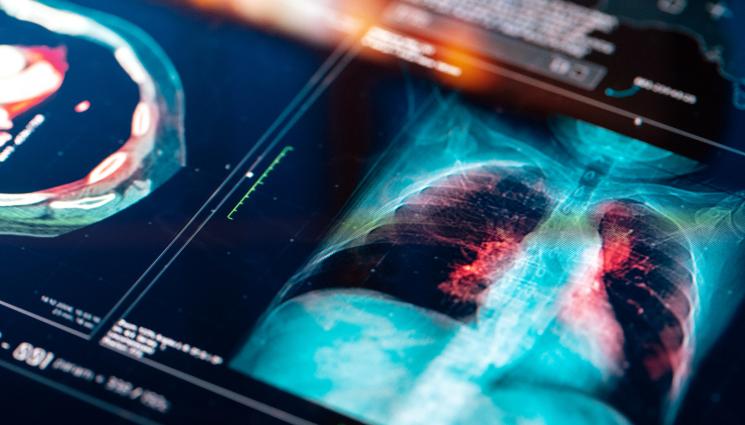 пневмония - ЗА ДВА МЕСЕЦА: Над 10 000 в болница заради пневмонии!