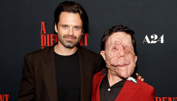 Адам Пиърсън - Актьор с ужасно заболяване се надява хората да не виждат в него „чудовище“