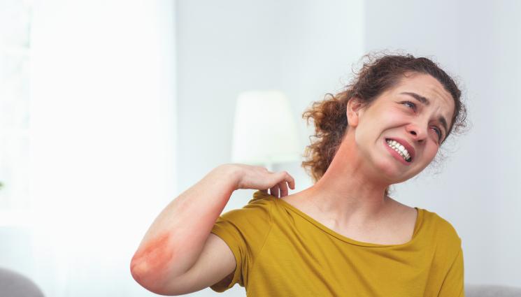 невродермит - ЗЛАТНО ВРЕМЕ: Живовляк гони невродермита