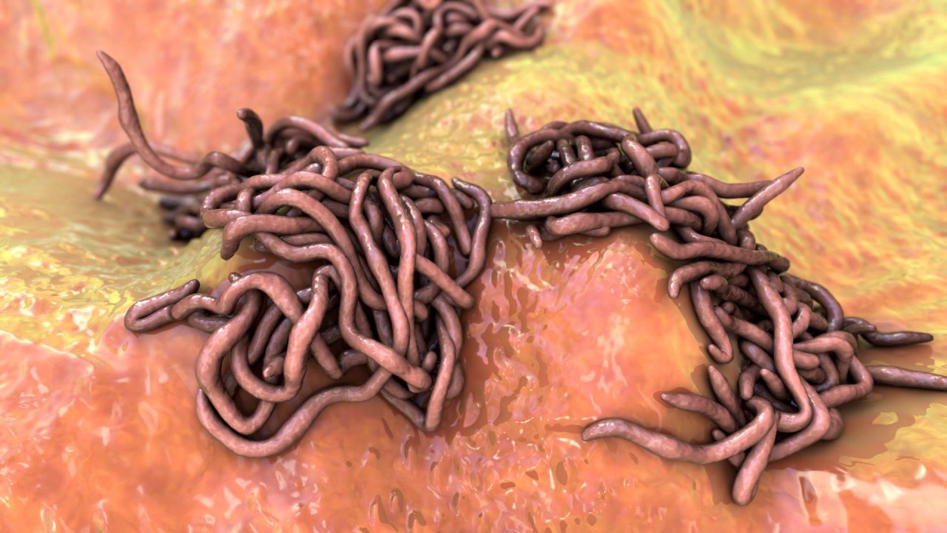 Какво представляват възпалителните чревни заболявания какви са причините за тях