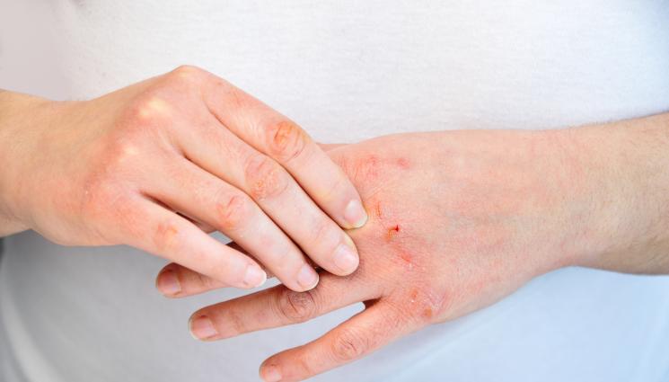 студова алергия - ЗЛАТНО ВРЕМЕ: Студова алергия хапе ръце и бузи