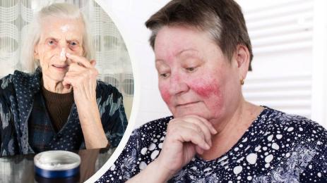 кожа дерматит