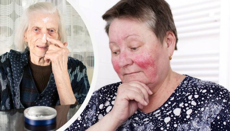 кожа дерматит - РИСКОВЕТЕ НА СЕЗОНА: Мъчи ни пролетен дерматит (Съветите на Баба Ванга при екзема)