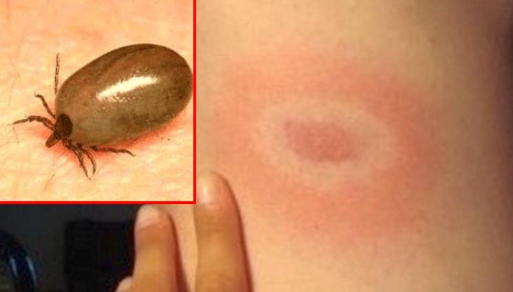 лаймска болест - РАЗМАХЪТ НА ЗАРАЗАТА РАСТЕ: Над 50% ръст на лаймската болест!