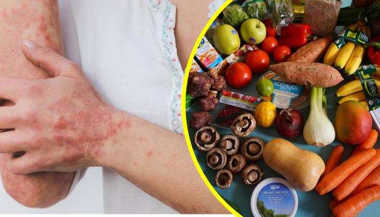 псориазис - ПОЛЕЗНО: Диета при псориазис