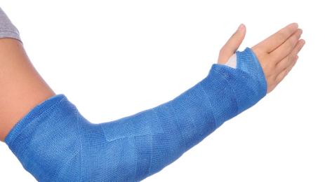гипсирана ръка