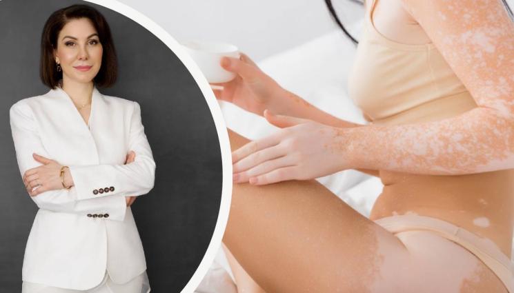 Снежана Атанасова витилиго - ЗДРАВЕ с Телеграф: 1/4 от пациентите заболяват от витилиго в детска възраст