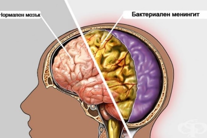менингит