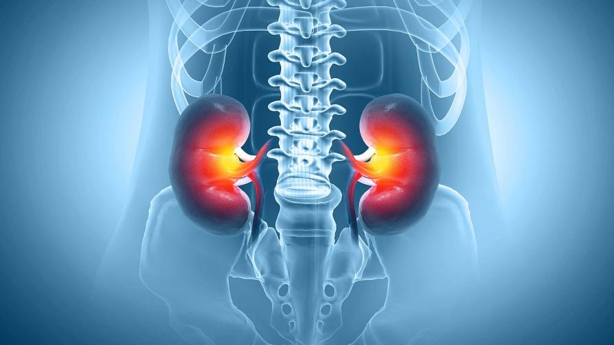 Рядък медицински случай: Мъж разви камъни в бъбреците от хранителни добавки