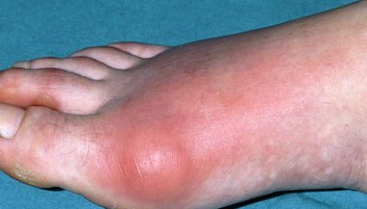 подагра - 10 домашни средства за намаляване на пикочната киселина