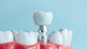зъби импланти