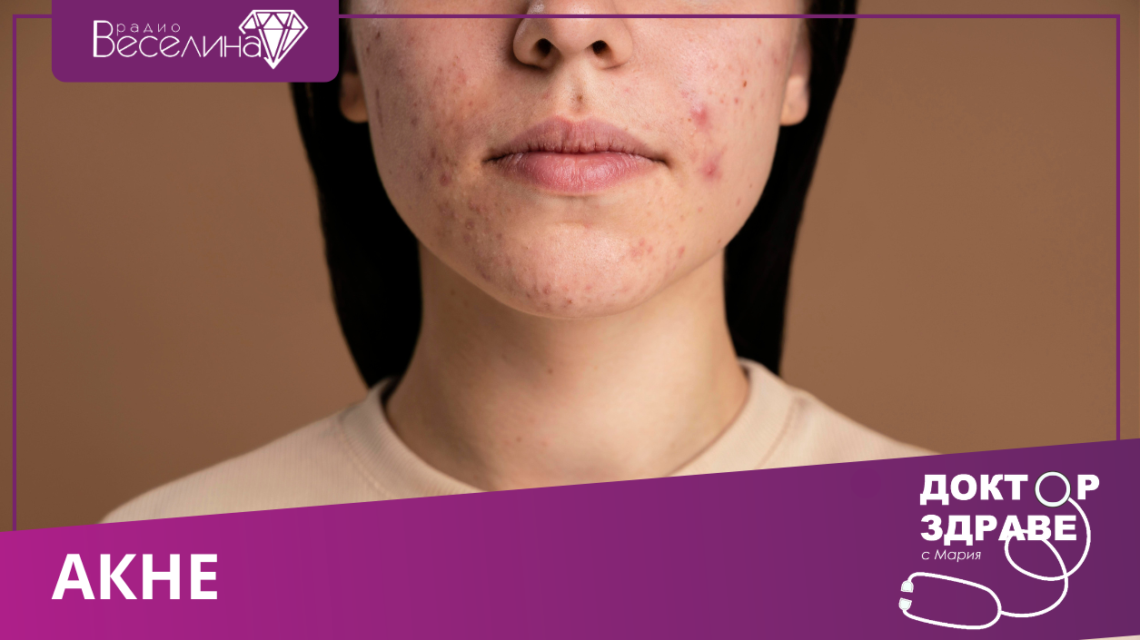 Акне - симптоми, причини и лечение