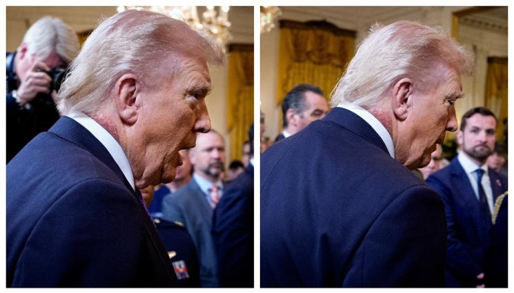 Тръмп - ВСИЧКИ ГЛЕДАТ КЪМ НЕГО: Странен обрив на врата на Тръмп, подложиха го на лечение