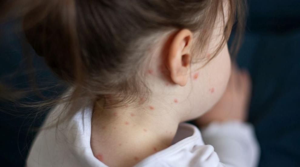 Морбили в България: инфекции сред деца и възрастни, рискът расте