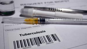 туберколоза