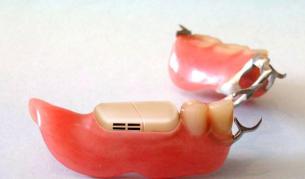 Зъбна протеза... с микрокомпютър