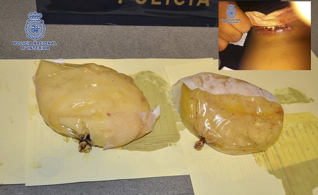 Четири години затвор заради измамата с гръдни импланти